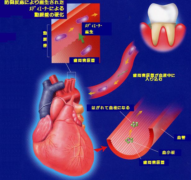 歯周病と血管系の病気