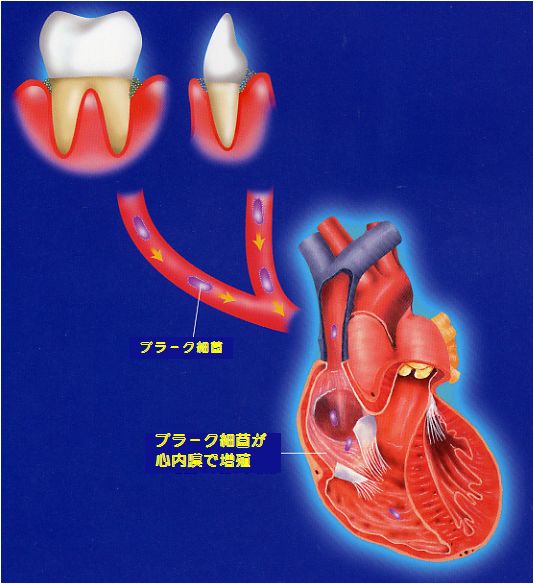 歯周病と心内膜炎