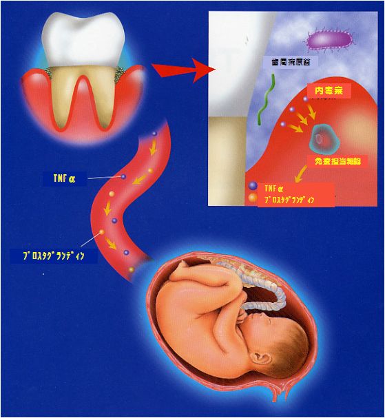 歯周病と低体重児出産