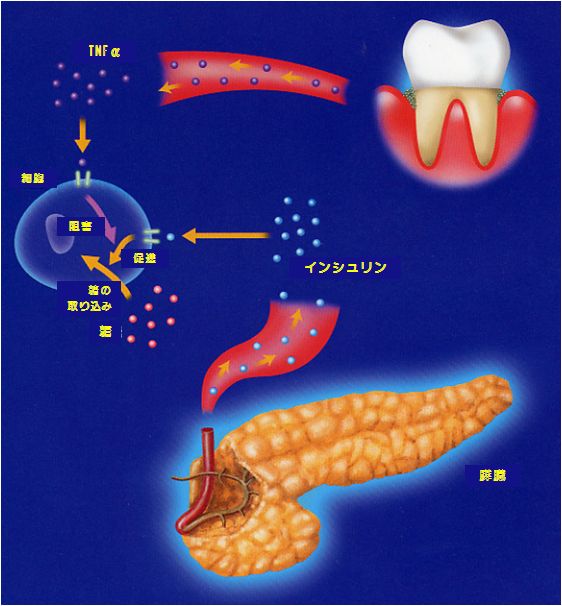 歯周病が糖尿病に影響する